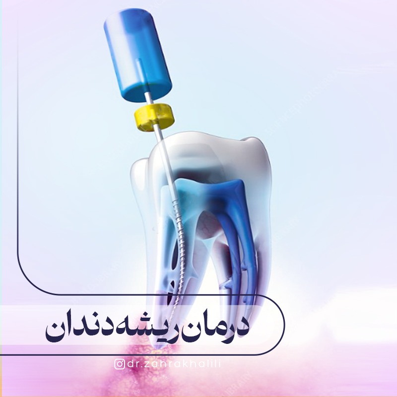 درمان ریشه دندان چگونه انجام می شود؟