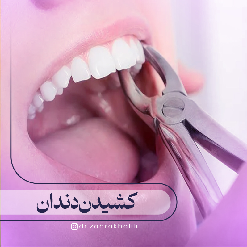 همه چیز درباره کشیدن دندان