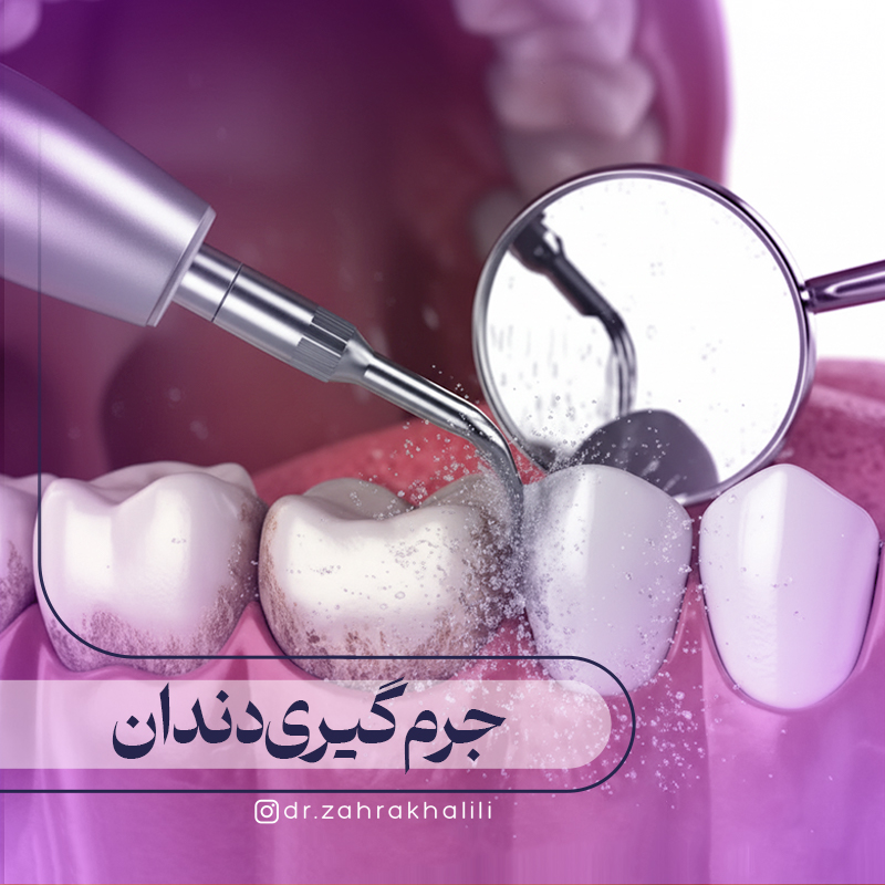 جرم‌گیری دندان چیست و چگونه انجام می شود؟