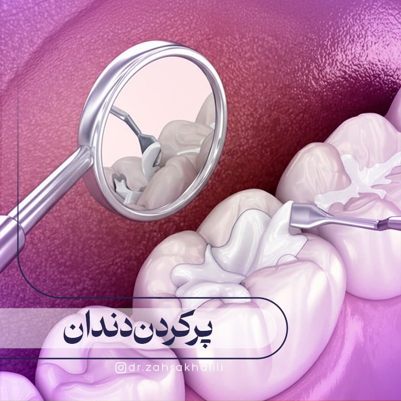 پرکردن دندان چگونه انجام می شود؟