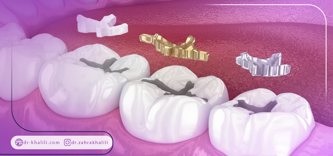 بهترین مواد برای پر کردن دندان ها چیست؟