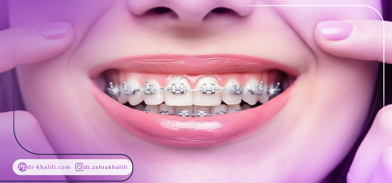 مزایای استفاده از ارتودنسی پیشگیرانه