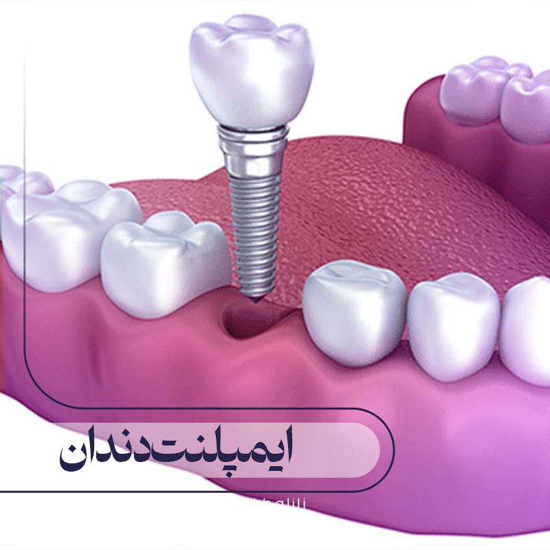 ایمپلنت دندان چیست؟