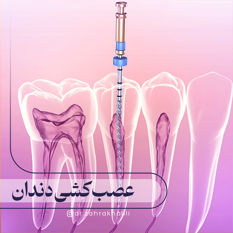 عصب کشی چگونه است؟