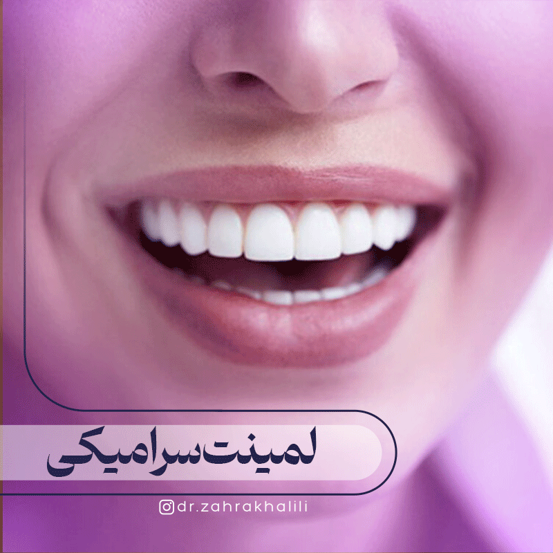 لمینت سرامیکی
