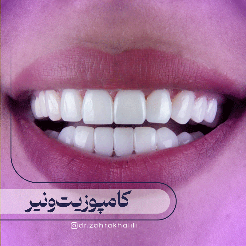 کامپوزیت ونیر
