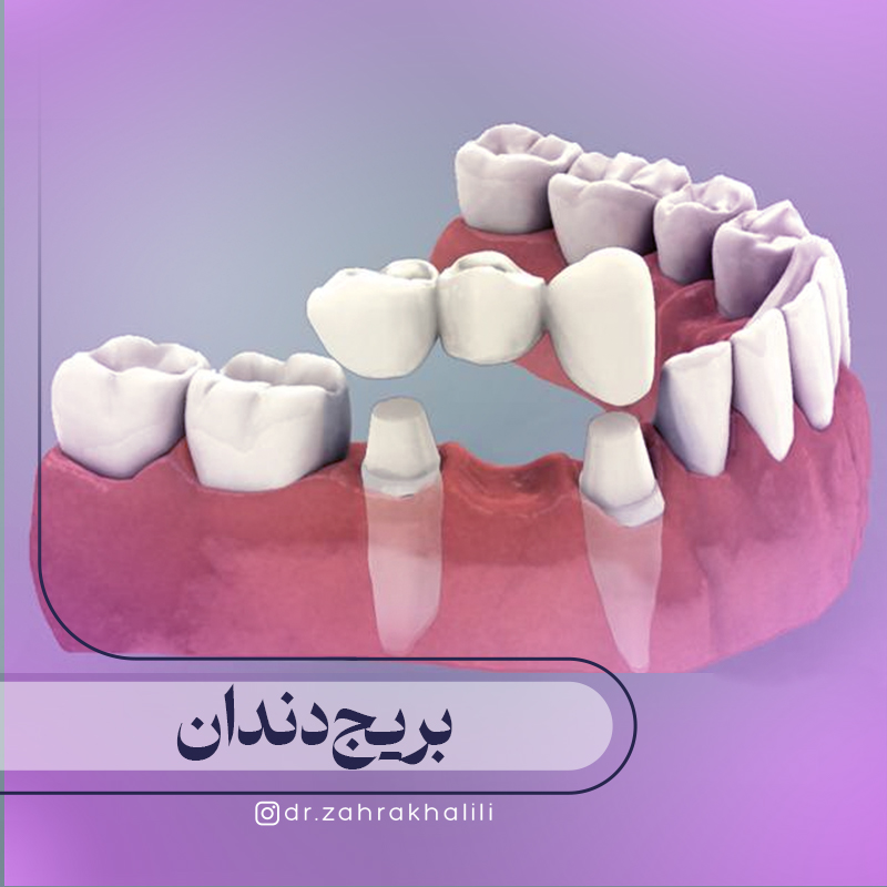 بریج دندان چیست و چگونه انجام می شود؟