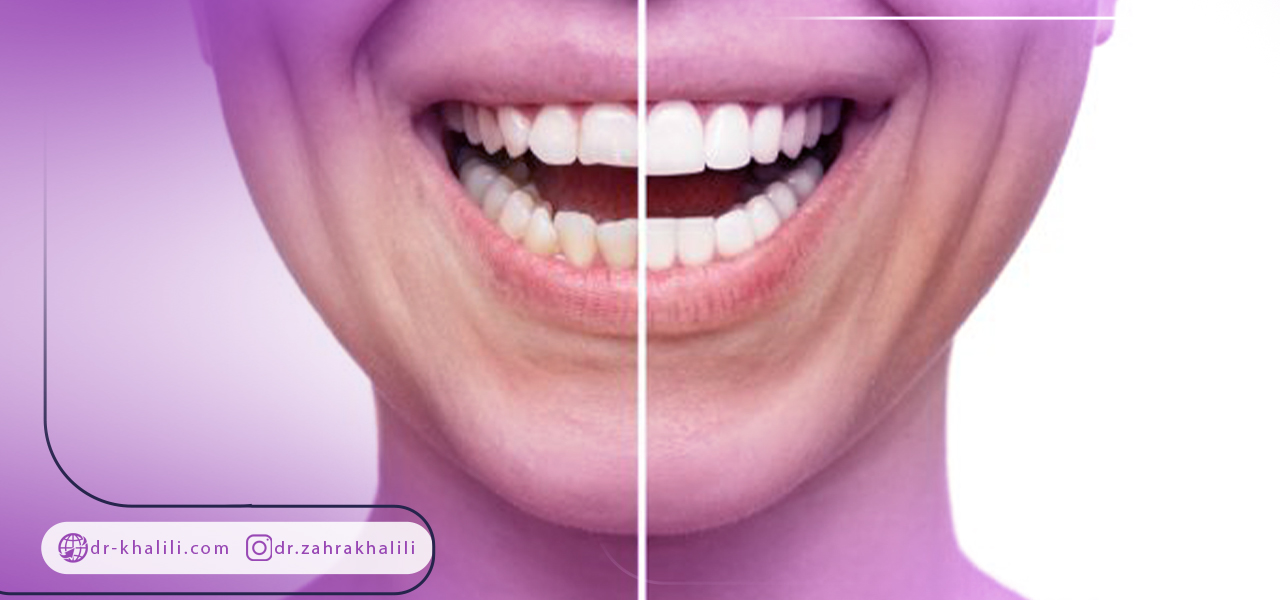 طول عمر روکش زیرکونیا