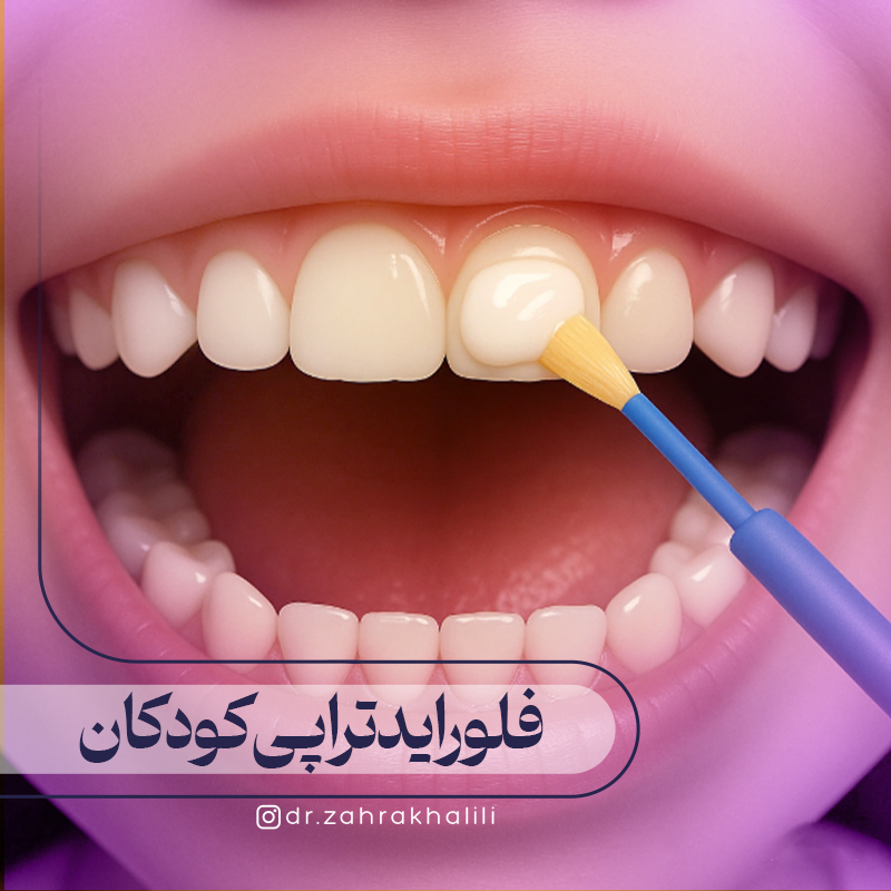 همه چیز درباره فلوراید تراپی کودکان