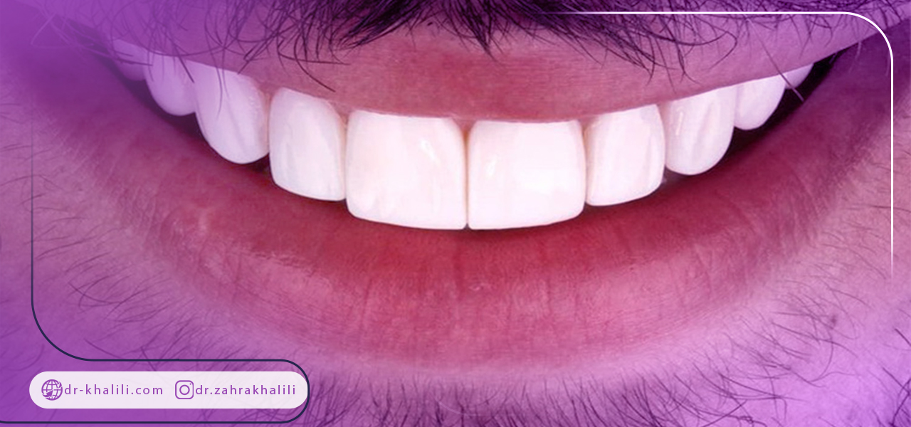 چگونگی نصب روکش پی اف ام