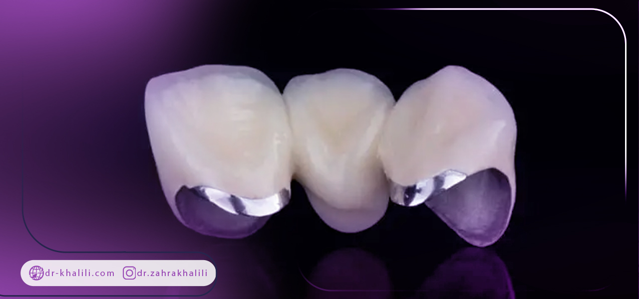 معایب استفاده از روکش پی اف ام