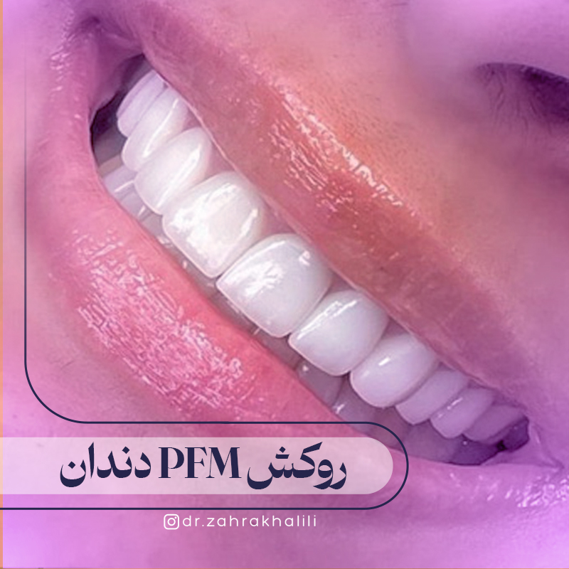 روکش پی اف ام (PFM) دندان چیست؟